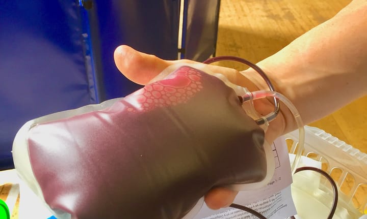 A completed unit of donated whole blood in a clear plastic bag, held up in one hand beside the donation tubing at a collection session.